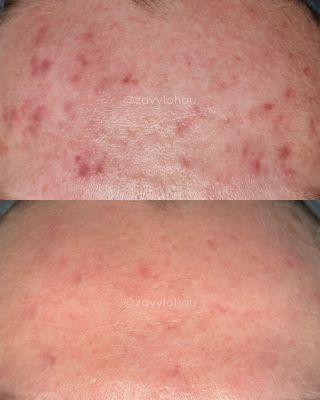 Od zánětlivého akné ➡️ k čisté, zdravé pleti. U klientky jsme začínaly s citlivou, zanícenou pletí a častými výsevy akné....