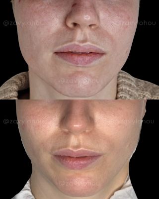 Na fotografii vidíte proměnu pleti klientky, která nás navštívila s cílem zmírnit citlivost, začervenání a podpořit...